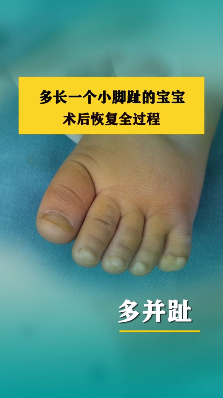 JJJ正式接受脚趾手术三个月后重新评估(脚趾头矫正手术费用)